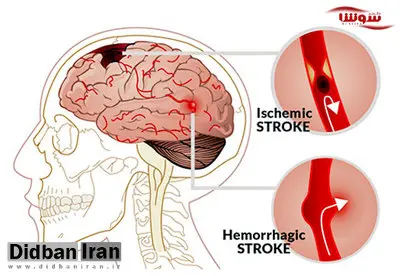 «جدی بگیرید» ؛ نشانه های سکته مغزی