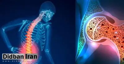 پوکی استخوان مهمانی ناخوانده که از دهه چهل وارد زندگی میشود