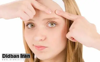 علت جوش پیشانی چیست و چگونه درمان می‌شود؟