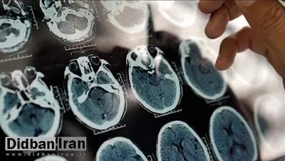 هشدار درباره شروع یک بیماری سخت از ۴۰ سالگی