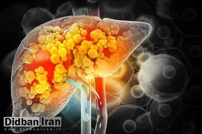 چگونه کبد چرب را درمان کنیم؟