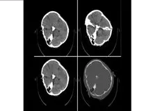 پاسخ متخصصین نرورادیولژی به استعلام رییس نظام پزشکی/ هیچ شواهدی از خونریزی مغزی در تصاویر سی‌تی‌اسکن «مهسا امینی» دیده نمی‌شود