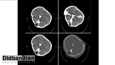 پاسخ متخصصین نرورادیولژی به استعلام رییس نظام پزشکی/ هیچ شواهدی از خونریزی مغزی در تصاویر سی‌تی‌اسکن «مهسا امینی» دیده نمی‌شود