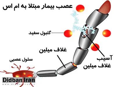 80 هزار ایرانی مبتلا به MS هستند/ زنان 4 برابر مردان درگیر بیماری
