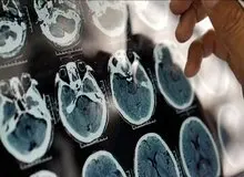 راهکار مؤثر برای پیشگیری از فراموشی و آلزایمر