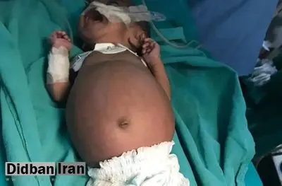 اتفاقی نادر در هند؛ تولد نوزادی که در شکمش جنین دوقلوی خود را داشت
