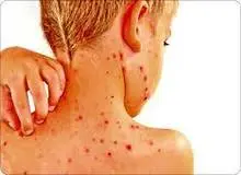 آبله میمون چیست و چه علائمی دارد