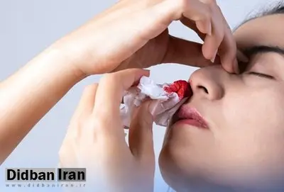 چرا در تابستان خوندماغ میشویم؟/ پیشگیری و راه درمان