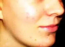 آکنه چیست و چگونه درمان می‌شود؟