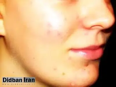 آکنه چیست و چگونه درمان می‌شود؟