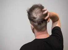 دانشمندان: مصرف زیاد نوشیدنی‌های شیرین می‌تواند ریزش مو را افزایش دهد