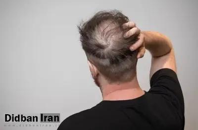 دانشمندان: مصرف زیاد نوشیدنیهای شیرین میتواند ریزش مو را افزایش دهد