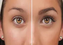 علت ریزش ابرو پس از کاشت چیست؟