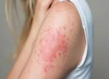 بهترین درمان‌ها برای کهیر مزمن کدام‌اند؟