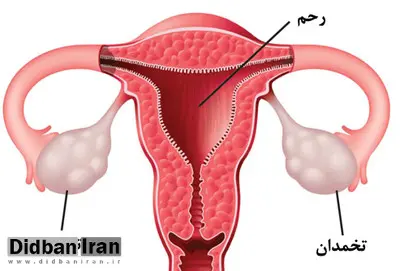 آشنایی با 10 نشانه هشدار دهنده سرطان تخمدان