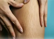 سلولیت چیست؟/۵ عامل ایجاد سلولیت در پوست