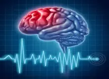 90 درصد سکته های مغزی بر اثر تشکیل لخته در عروق مغزی به وجود می آید