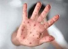 همه چیز درباره شیوع HFMD در مدارس/ کدام دانش‌آموزان نباید به مدرسه بروند؟