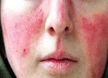 سرطان های پوستی جز 6 سرطان شایع در جهان