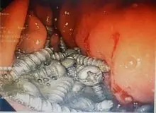  ۴۷ پیچ فلزی از معده یک بیمار در کرج خارج شد 