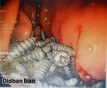 ۴۷ پیچ فلزی از معده یک بیمار در کرج خارج شد