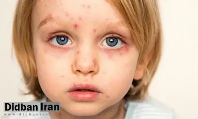 این گروه واکسن آبله‌مرغان بزنند