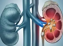۶ باور غلط درباره سنگ‌های ادراری در بین مردم