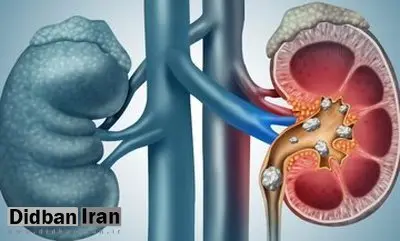 ۶ باور غلط درباره سنگهای ادراری در بین مردم