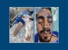 کولبر ۲٤ ساله سردشت چشم چپ و پای راستش را از دست داد