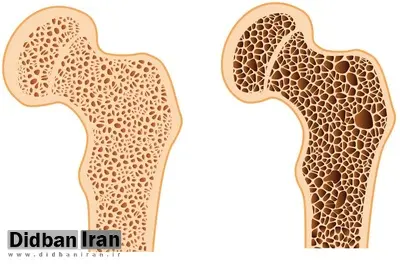 سبک زندگی ناسالم، مهم ترین عامل ابتلا به پوکی استخوان