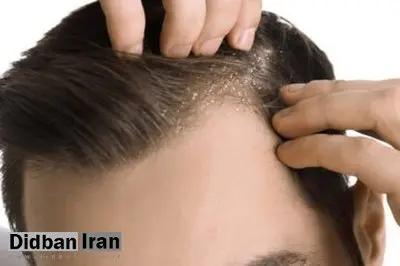 مهم‌ترین علت‌های شوره سر+ راه های درمان