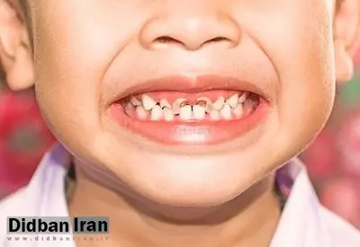آمار پوسیدگی دندان در بین دانش آموزان رو به افزایش است