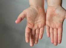 آخرین وضعیت شیوع سرخک در ایران/ بیشتر مبتلایان اتباع خارجی هستند