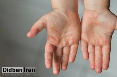 آخرین وضعیت شیوع سرخک در ایران/ بیشتر مبتلایان اتباع خارجی هستند