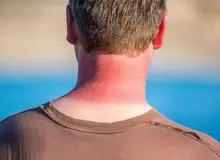 آفتاب‌سوختگی را چطور درمان کنیم؟