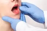 اصلی‌ترین عوامل خطر در سرطان دهان چیست؟/ علائم هشدار دهنده