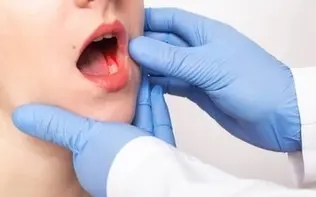 اصلی‌ترین عوامل خطر در سرطان دهان چیست؟/ علائم هشدار دهنده