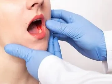 اصلی‌ترین عوامل خطر در سرطان دهان چیست؟/ علائم هشدار دهنده