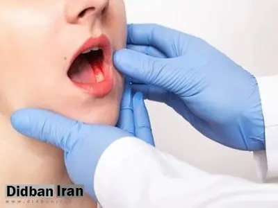 اصلی‌ترین عوامل خطر در سرطان دهان چیست؟/ علائم هشدار دهنده