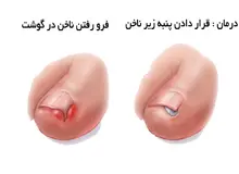 وقتی ناخن پا در گوشت فرو می رود