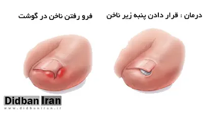 وقتی ناخن پا در گوشت فرو می رود