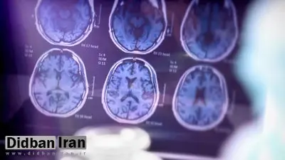 معمای جوانترین فرد مبتلا به آلزایمر؛ افت ناگهانی سطح حافظه «بدون جهشهای بیماریزا»