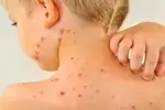 سرخک دوباره برگشت! / سازمان جهانی بهداشت هشدار داد