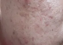 آکنه مکانیکا چیست؟ درمان‌های خانگی برای مقابله با آن