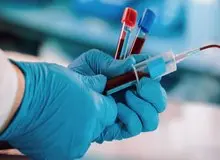 فصد خون چه فوایدی دارد؟