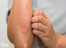  بیماری «سپسیس»  چیست؟+علائم و نشانه های 