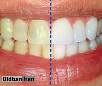 جرم دندان سبب ابتلا به سکته قلبی و مغزی می شود