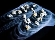 ریه پاپ‌کُرنی؛ بیماری خطرناکی که می‌تواند با کشیدن ویپ پدید آید