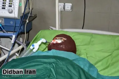 اسیدپاشی هولناک روی پدر و دختر