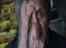 ببینید: بیماری نادر چهره این مرد را وحشتناک کرده است+ فیلم 